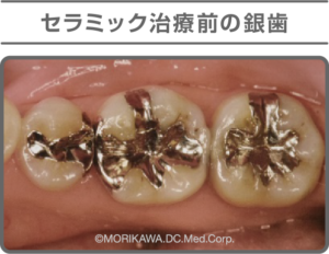 八尾市　歯医者　セラミック治療前の銀歯