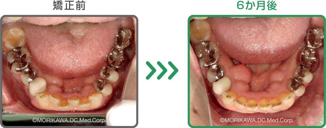 八尾市　歯医者　左は矯正前、右は6か月後