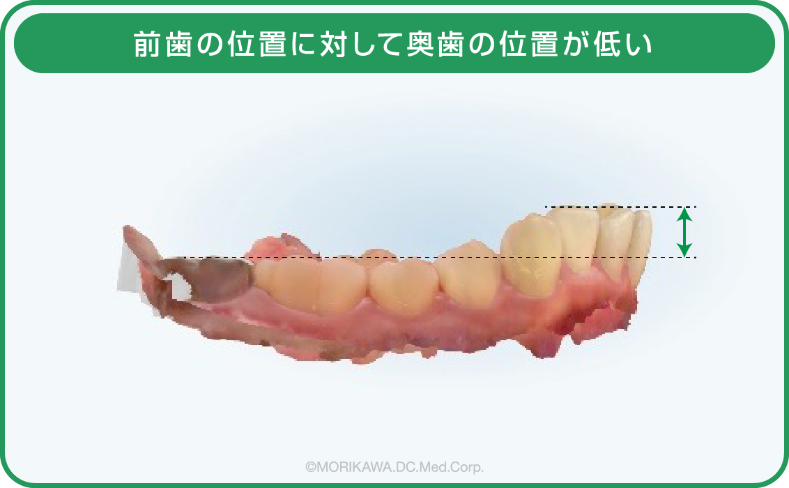八尾市　歯医者　前歯の位置に対して奥歯の位置が低い