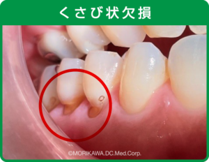 八尾市　歯医者　くさび状欠損